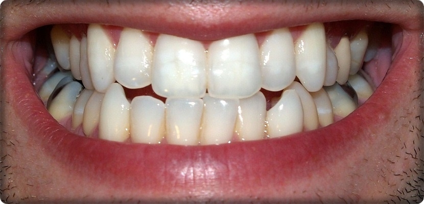 دراسة: الأسنان تساعد على تشخيص الصحة العقلية