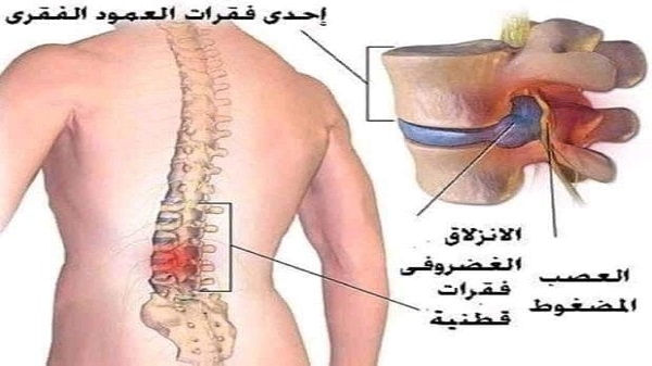 الانزلاق الغضروفي لارني ديسكال ديسك عرقالنسا